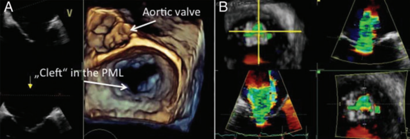 MitraClip procedure for the treatment of a pseudo-cleft in the posterior mitral leaflet