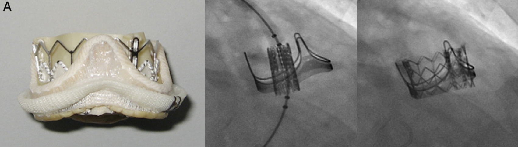 Transcatheter Valve-in-Valve Implantation for Failed Surgical Bioprosthetic Valves