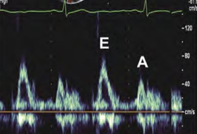 New recommendations for the evaluation of left ventricular diastolic function by echocardiography