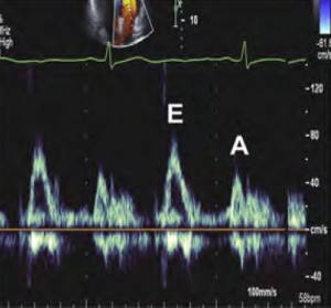 New recommendations for the evaluation of left ventricular diastolic function by echocardiography
