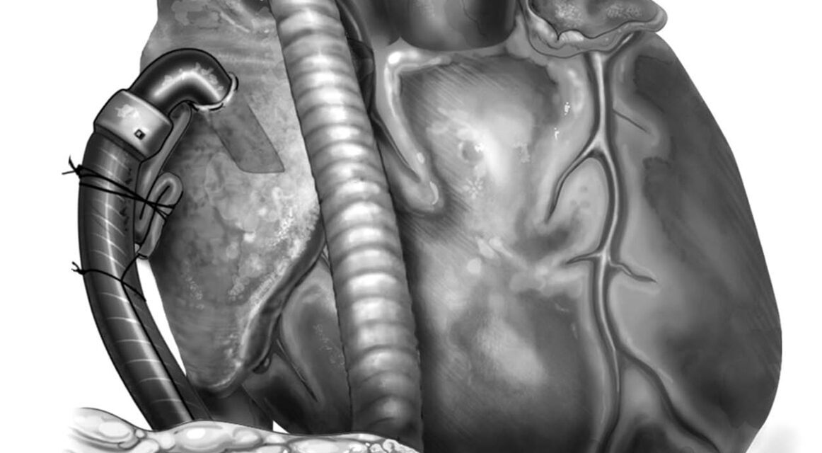 Advanced Heart Failure – MCS Symposium