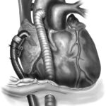 Advanced Heart Failure – MCS Symposium