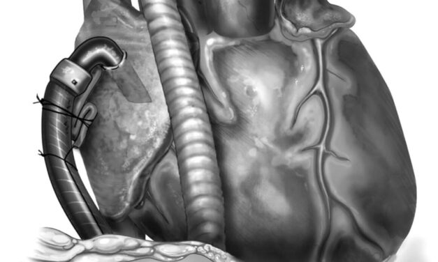 Advanced Heart Failure – MCS Symposium